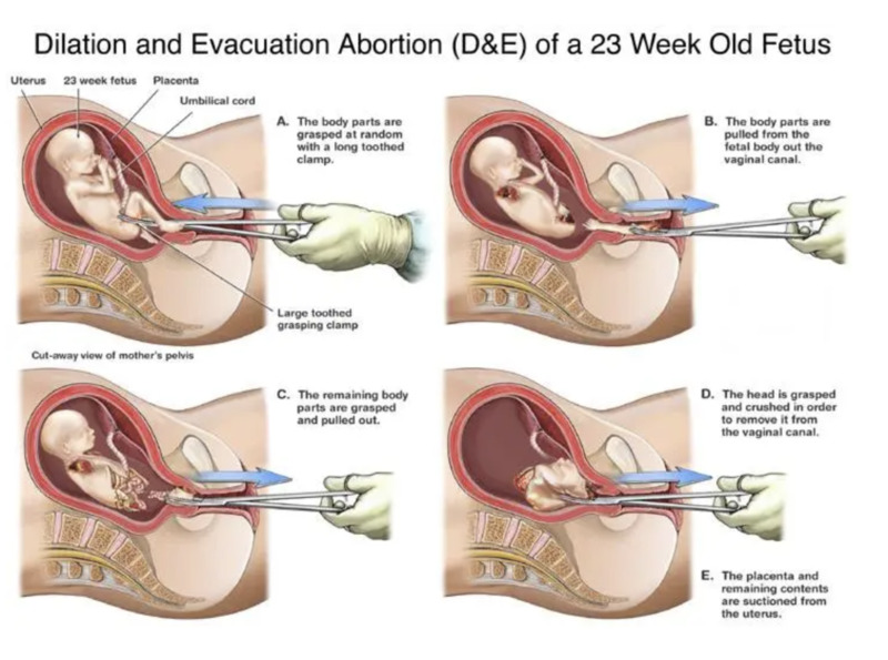 Chart produced by the National Right to Life organization depicting the steps to a PBA. The fetus depicted is quite life-like and the chart is exaggerating the gruesomeness of the procedure. 